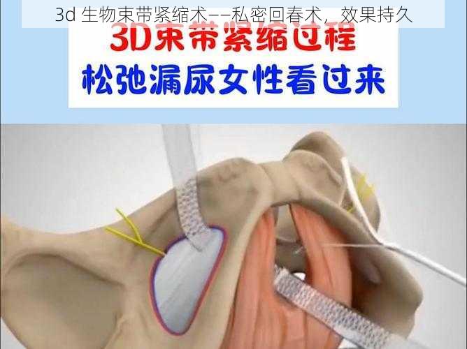 3d 生物束带紧缩术——私密回春术，效果持久